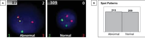 Figure 2 From Runx1runx1t1 Fusion In Pediatric Acute Myeloid Leukemia