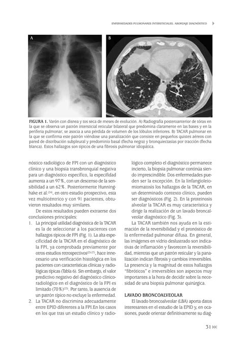 Enfermedades pulmonares intersticiales Abordaje Diagnóstico pdf