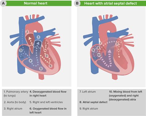 Pediatric Atrial Septal Defects Classification And Surgery Lecturio