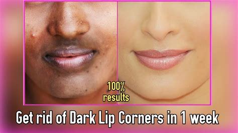 How To Get Rid Of Dark Corners Around Lips Lipstutorial Org