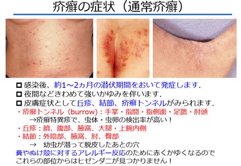 【皮ふの疾患について】見逃せない疥癬の診断とその知識（医療従事者むけ） Yanase Derma’s Diary