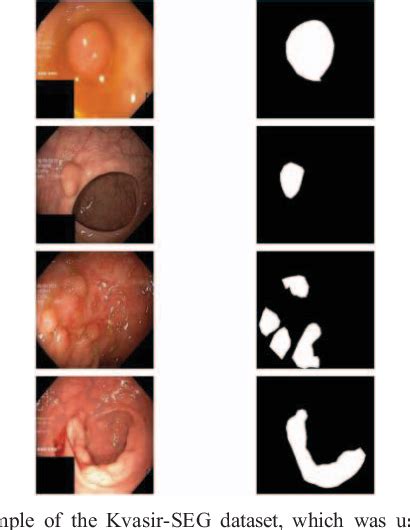 Figure 2 From Towards Real Time Polyp Segmentation During Colonoscopy