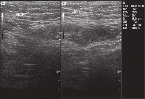 Inguinal Canal Hernia Ultrasound