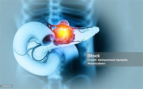 췌장암은 췌장 세포에서 형성되는 암입니다 3d 그림 췌장에 대한 스톡 사진 및 기타 이미지 췌장 암 췌장암 Istock