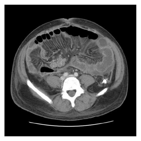 CT Abdomen And Pelvis Revealing Enlarged Mesenteric Lymph Nodes And