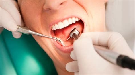 Qué es un curetaje dental y para qué sirve Es bueno