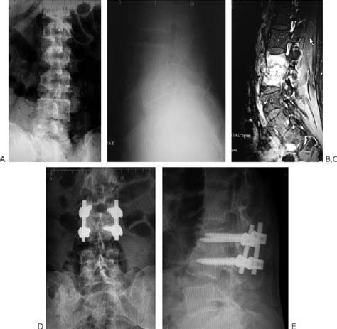 Case Of Pyogenic Vertebral Osteomyelitis Pvo With Minimal