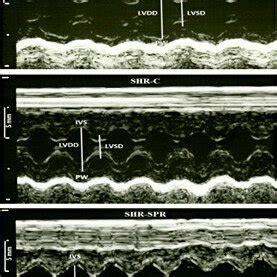 Illustrative Left Ventricle M Mode Echocardiograms Lvdd And Lvsd Left