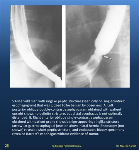 Esophageal Strictures