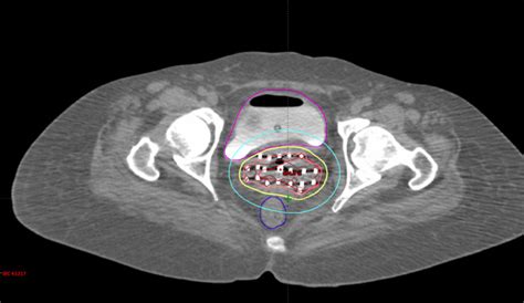 Interstitial Brachytherapy For Cervical Cancer - Dr. Vineeta Goel