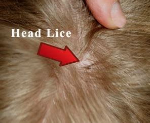 Natural Ayurveda Home Remedies for Head Lice – Ayurved Doctor