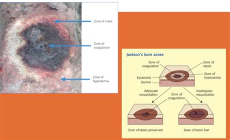 Burns And Chronic Wounds Flashcards Quizlet