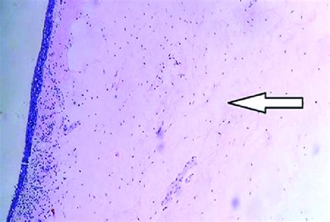 Micrograph of larynx showing laryngeal edema (H&E,400x magnification ...