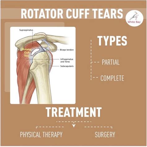 Types Of Rotator Cuff Tears