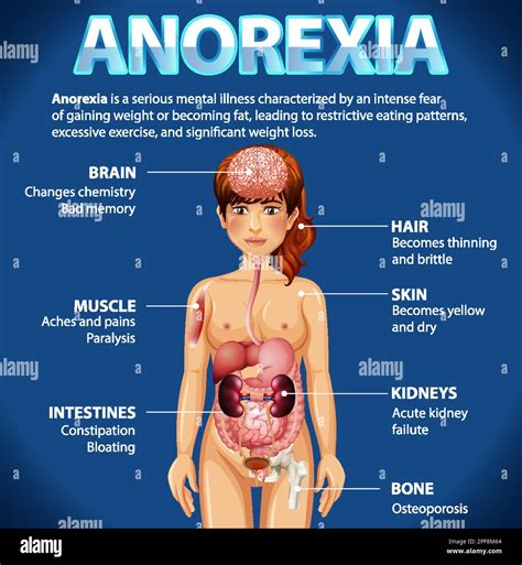 Informative Poster Of Anorexia Eating Disorder Illustration Stock