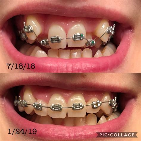 Bottom braces going on soon. : r/braces