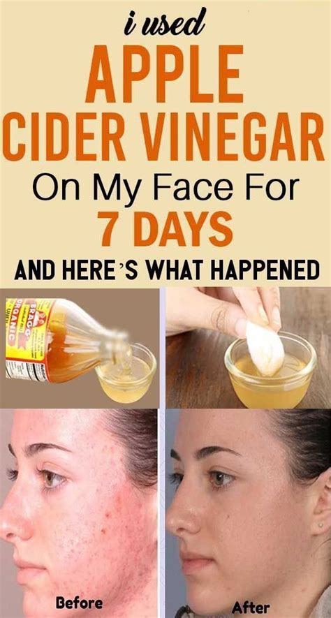 Skin Treatment Solution For Your Apple Cider Vinegar For Skin Apple Cider Vinegar Face