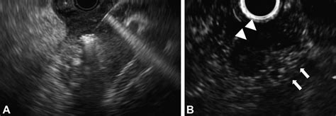 Imaging Of Eus Guided Radiofrequency And Follow Up Contrast Enhanced