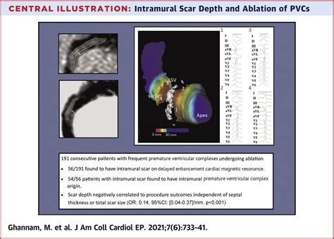 Impact Of Intramural Scar On Mapping And Ablation Of Premature