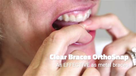 Clear Braces Orthosnap Youtube