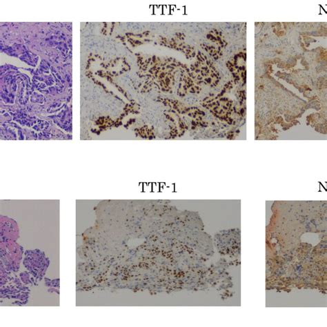 Pathological Findings And Epidermal Growth Factor Receptor EGFR