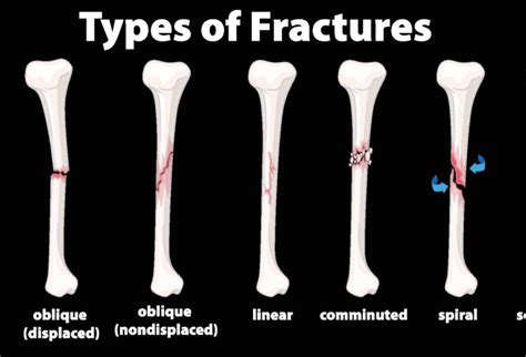 Types Of Fractures The Things You Need To Know Opa