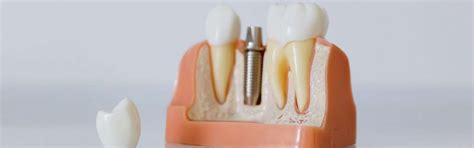 Do Dental Implants Hurt Managing Pain And Discomfort