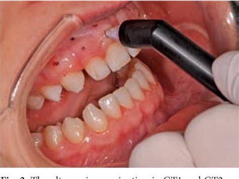 Methods Of Assessing Gingival Biotype Dental By Hadeel المسلسل من