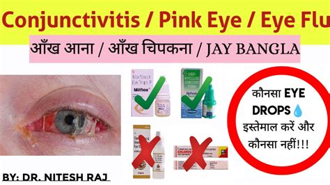 Eye Infectionconjunctivitiseye Flupink Eyejoy Bangalaआंख चिपकनाआंख आनाtreatmentbest Eye