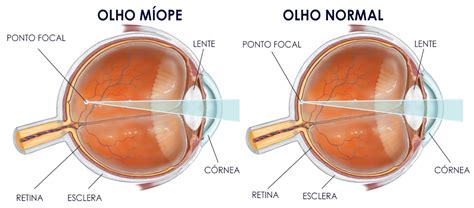 Miopia Ghisi Oftalmocl Nica