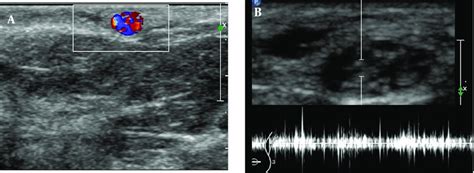 A Color Doppler Sonogram Shows Mixed Color Doppler Signals Due To