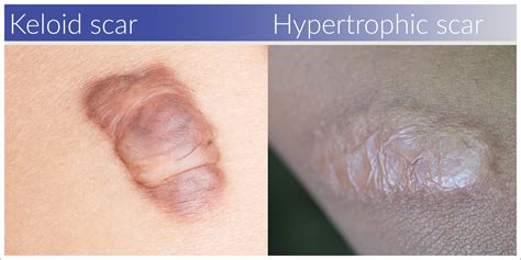 Hypertrophic Scar Vs Keloid