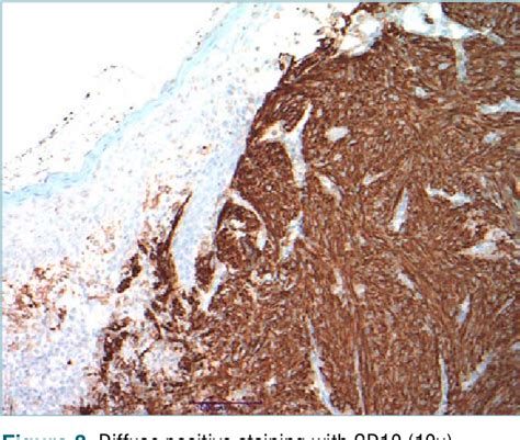 Figure 1 From Atypical Fibroxanthomapleomorphic Dermal Sarcoma Of The