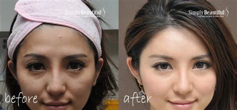 Forehead Temple Face Dermal Filler Injection Dr Peter Kim Surgery