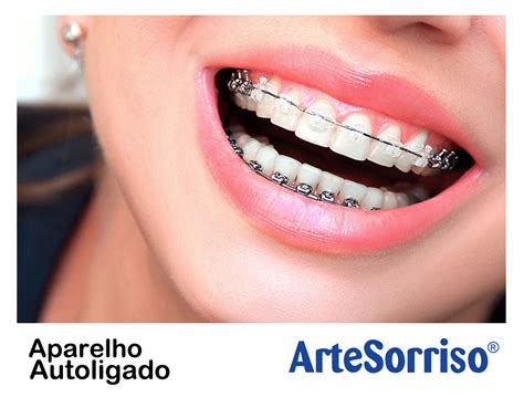 Benefícios do aparelho autoligado Dentista Ingleses Florianópolis