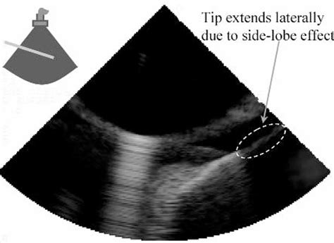 Imaging Artifacts Of Medical Instruments In Ultrasound‐guided Interventions Huang 2007