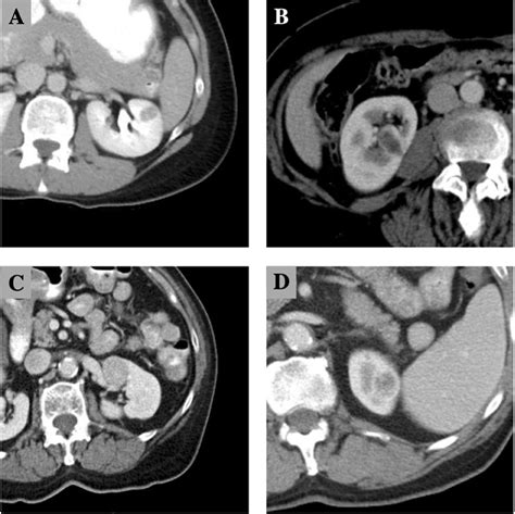 Feasibility And Outcomes Of Renal Mass Biopsy For Anatomically Complex