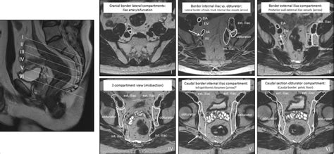 Anatomical boundaries of lateral lymph node stations (external iliac,... | Download Scientific ...