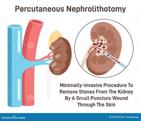 Nefrolitotomia Percutanea Pietra Renale Che Rimuove La Chirurgia