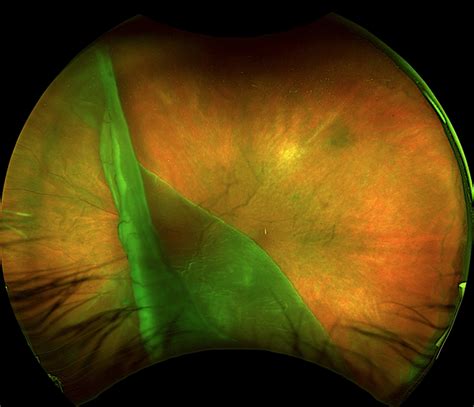 Giant Retinal Tear Retina Image Bank