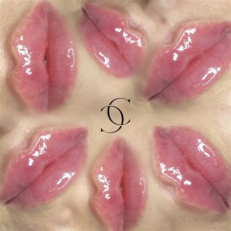 Lip Filler Techniques Advanced Aesthetics Specialist Perth Scotland