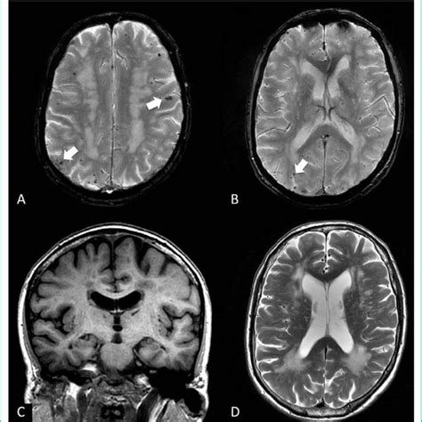 (PDF) Cerebral amyloid angiopathy presenting with neuropsychiatric symptoms