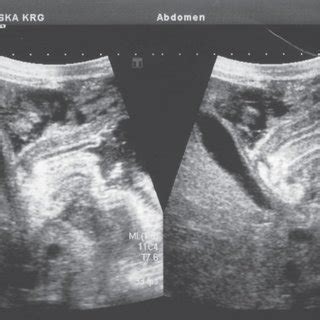 Transverse ultrasound image of the pylorus after pyloromyotomy, with ...