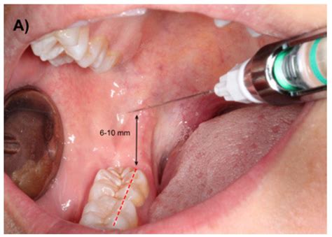 Inferior Alveolar Nerve Block Landmarks