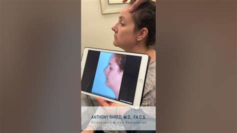 Female Rhinoplasty Anthony Bared Md Facs Miami Fl Youtube