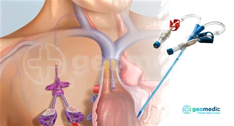 Cat Ter Venoso Central En Hemodi Lisis Gu A Integral Y Consideraciones