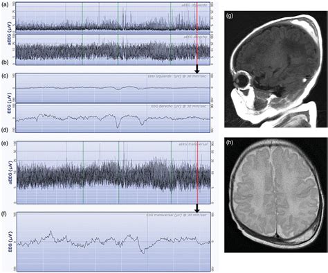 Example Of Amplitude Integrated Electroencephalogram Aeegeeg