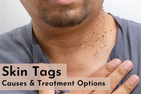 All About Skin Tags Cause Treatment Options SkinQure