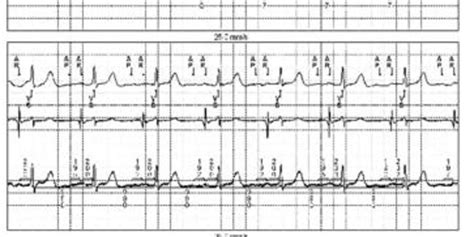 Atrial Pacing Failure Cardiocases