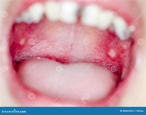 Infection Of Ulcer Inside Mouth Stock Image Image Of Filling Disease